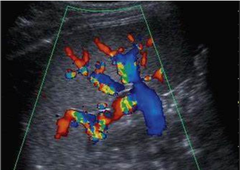 Ultrasound Evaluation of the Spleen